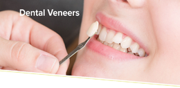 Dental Veneers