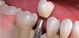 Dental Implants