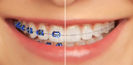 Dental Braces