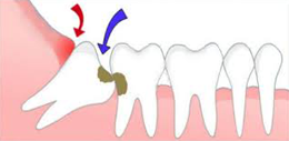 Wisdom Tooth Extraction