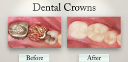 Ceramic Crowns